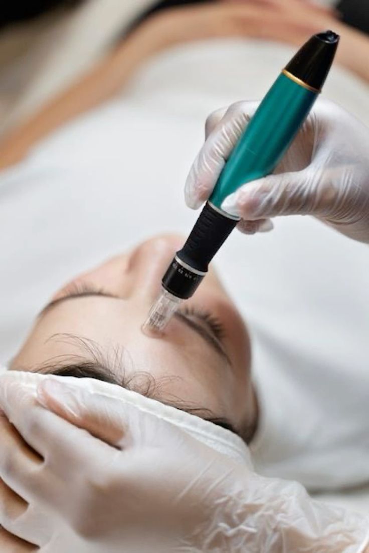 Microneedling – Face Only